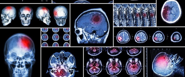 traumatic brain injuries